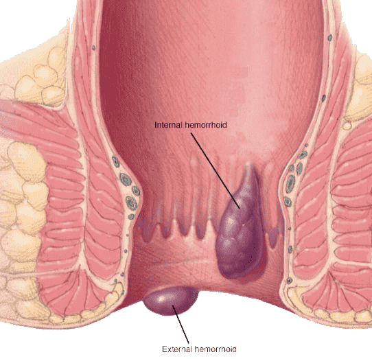 Piles Treatment