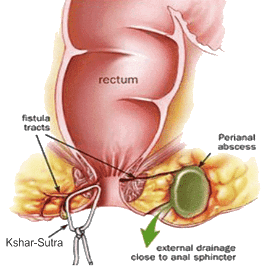 anal-fistula